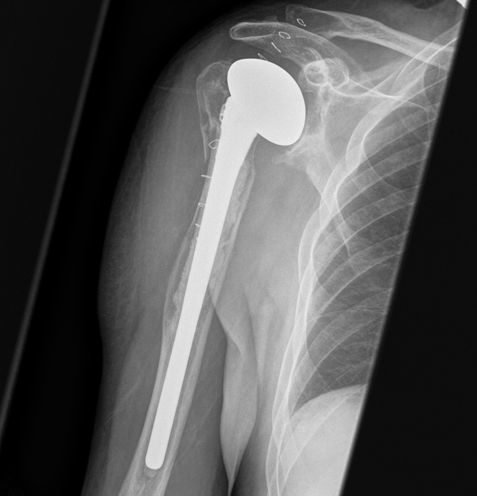 Revision TSR Long Stem Cemented Humeral Component